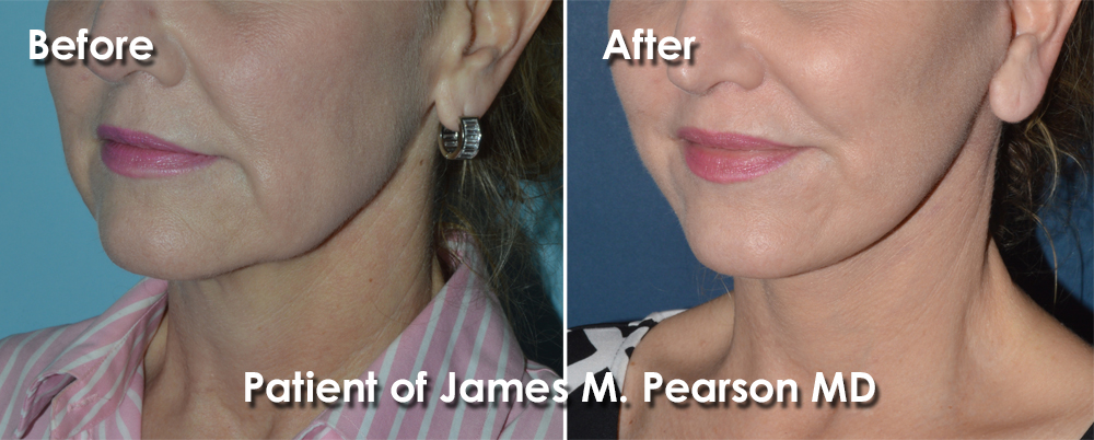 Pearson Facelift
