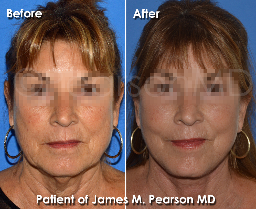 Pearson Facelift