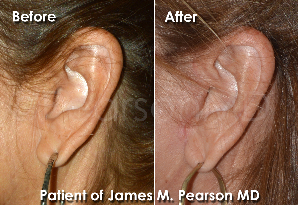 Photo Manhattan Beach Facelift Dr. James Pearson Facial Plastic Surgery Dr. Pearson Facelift