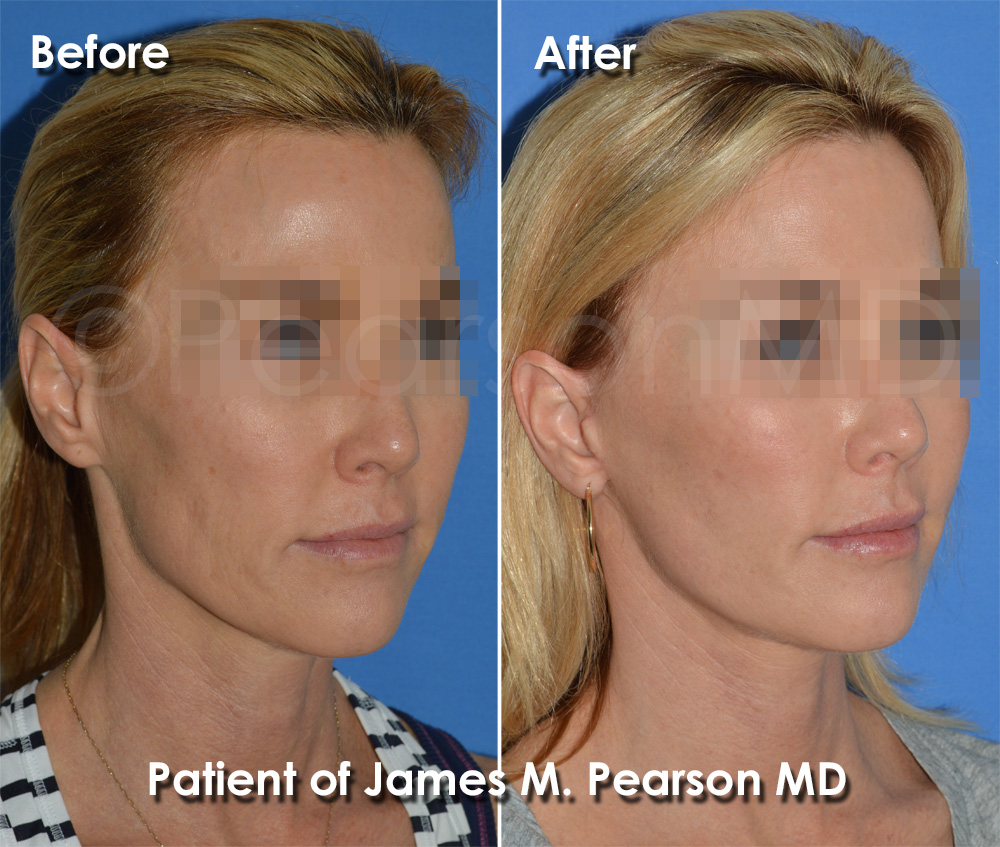 Pearson Facelift