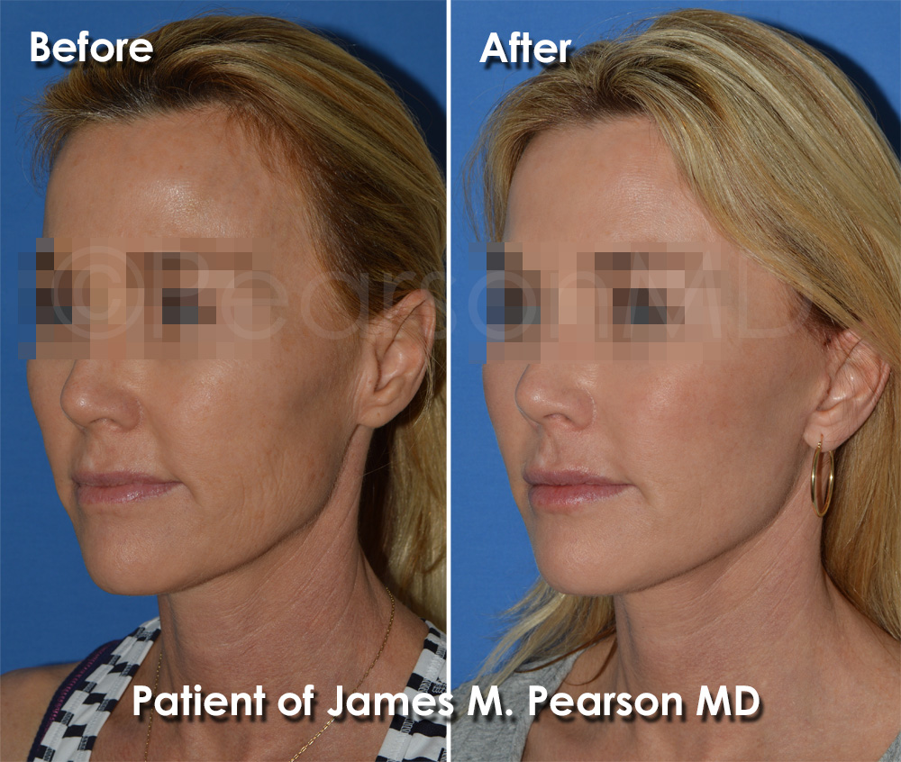 Dr. Pearson Facelift