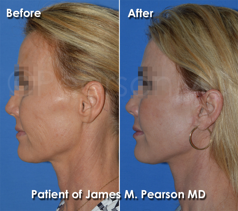Los Angeles Facelift