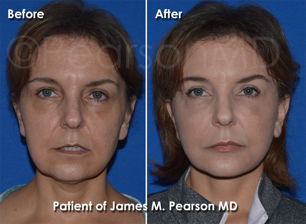 Manhattan Beach Facelift
