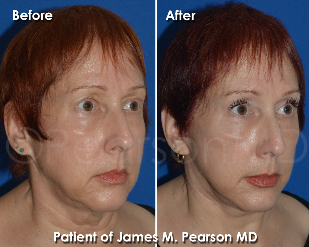 Dr. Pearson Facelift