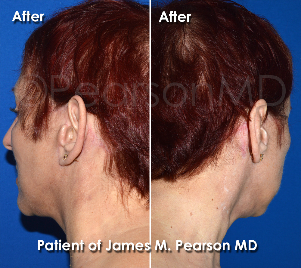 Dr. Pearson Facelift