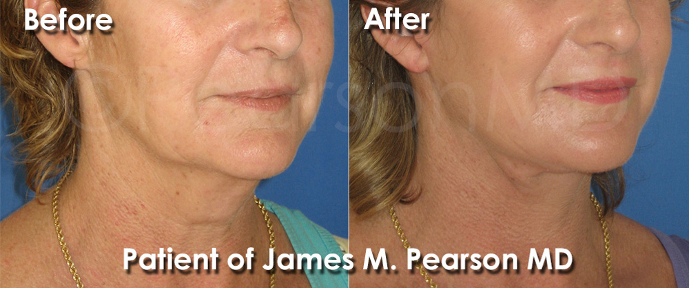 Pearson Cosmetic Surgery