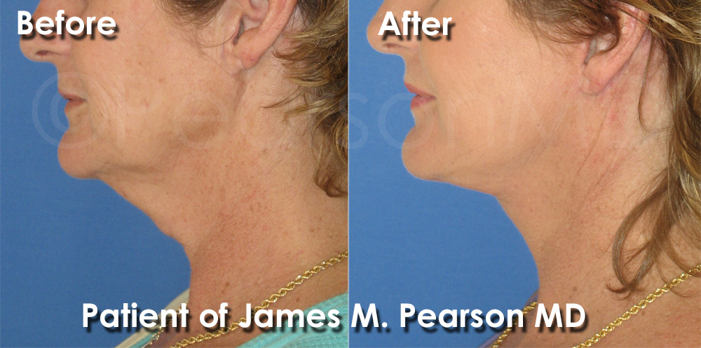 Dr. Pearson Facelift