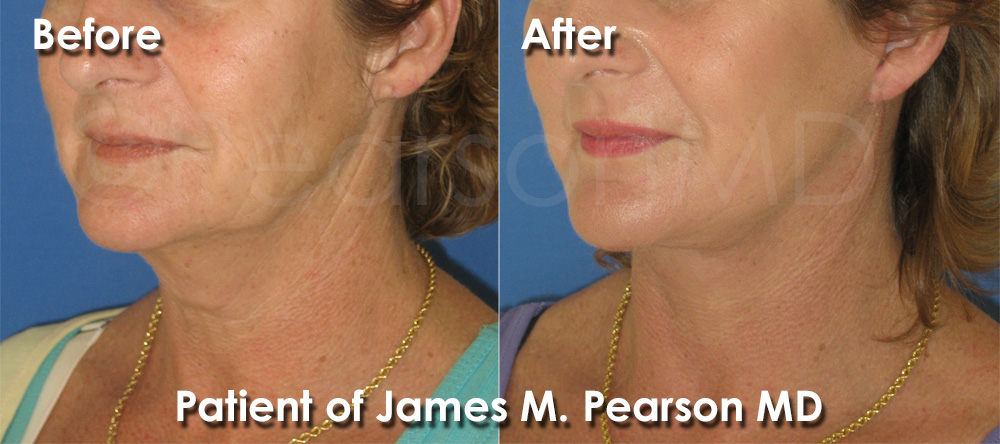 Dr. Pearson Neck Lift
