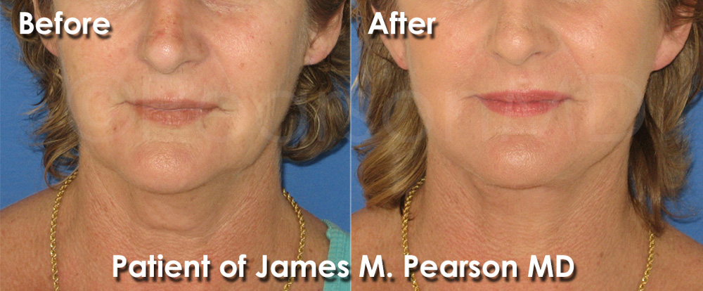 Pearson Plastic Surgery