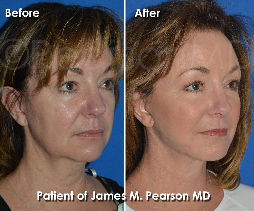 Pearson Neck Lift