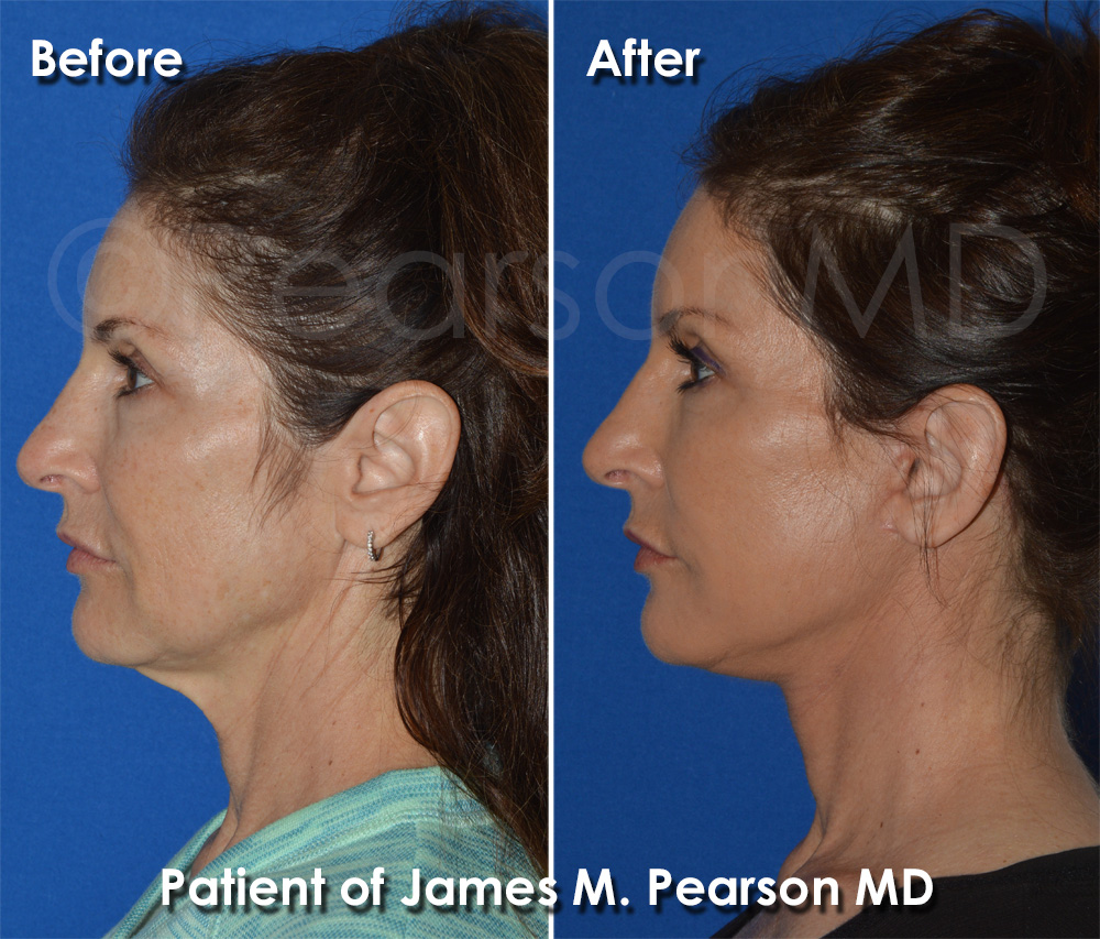 Pearson Plastic Surgery