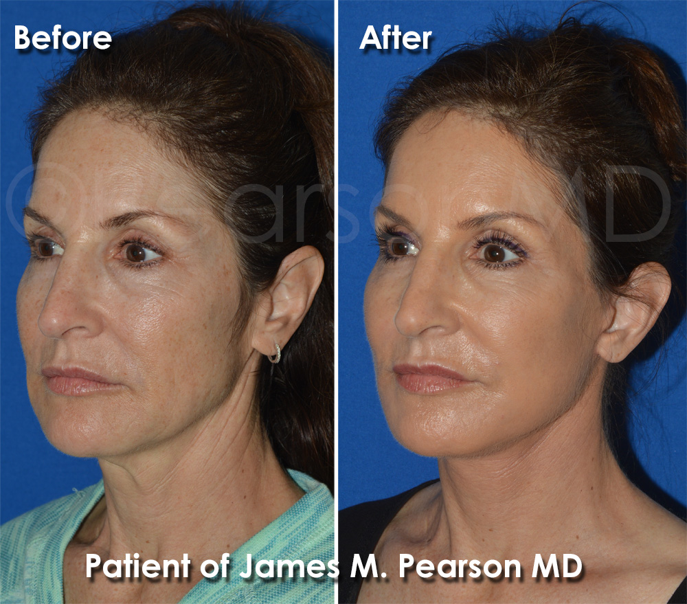 Manhattan Beach Facelift