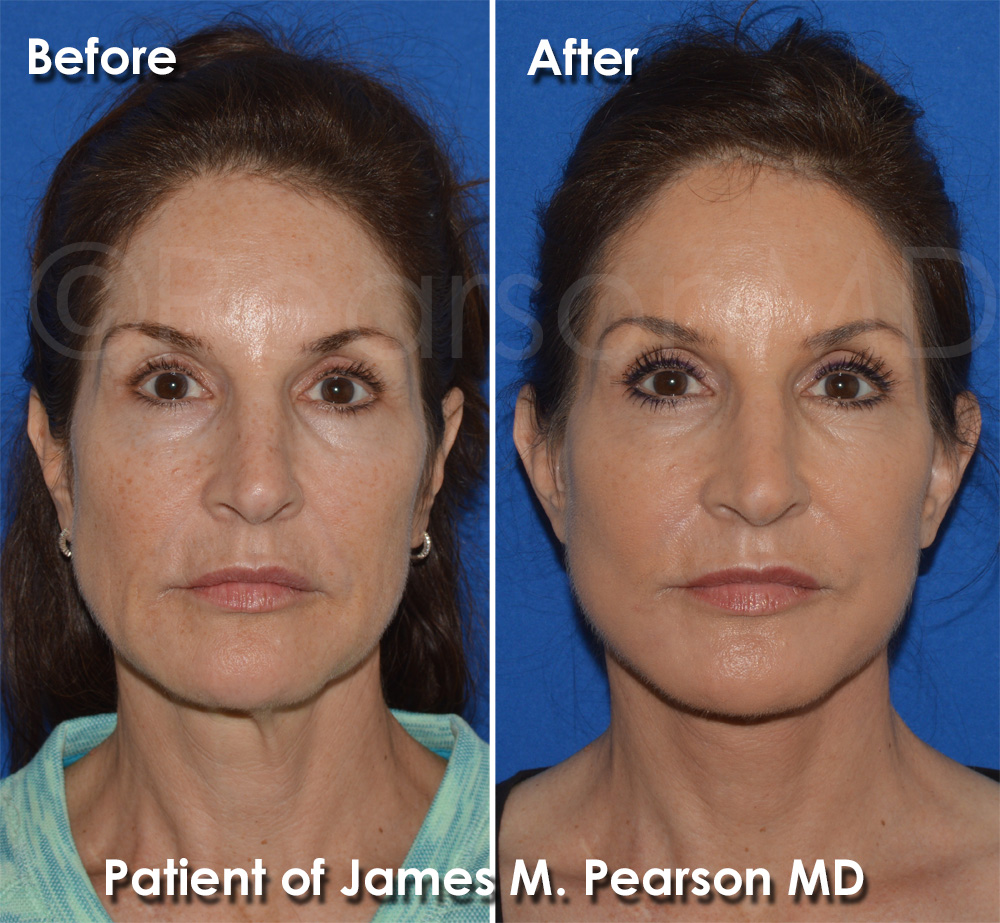 Hermosa Beach Facelift