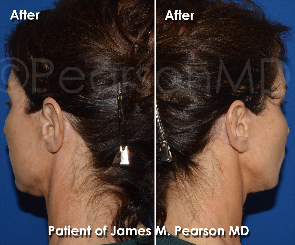 Hermosa Beach Facelift