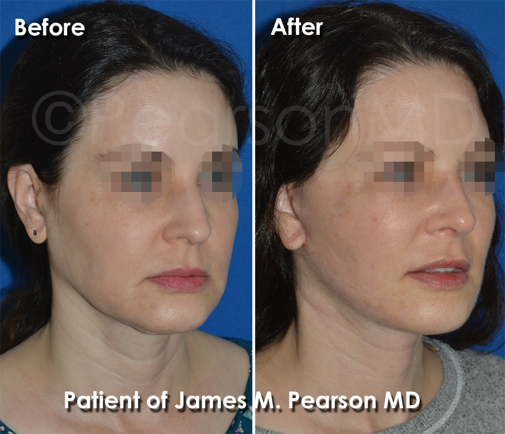 Pearson Plastic Surgery