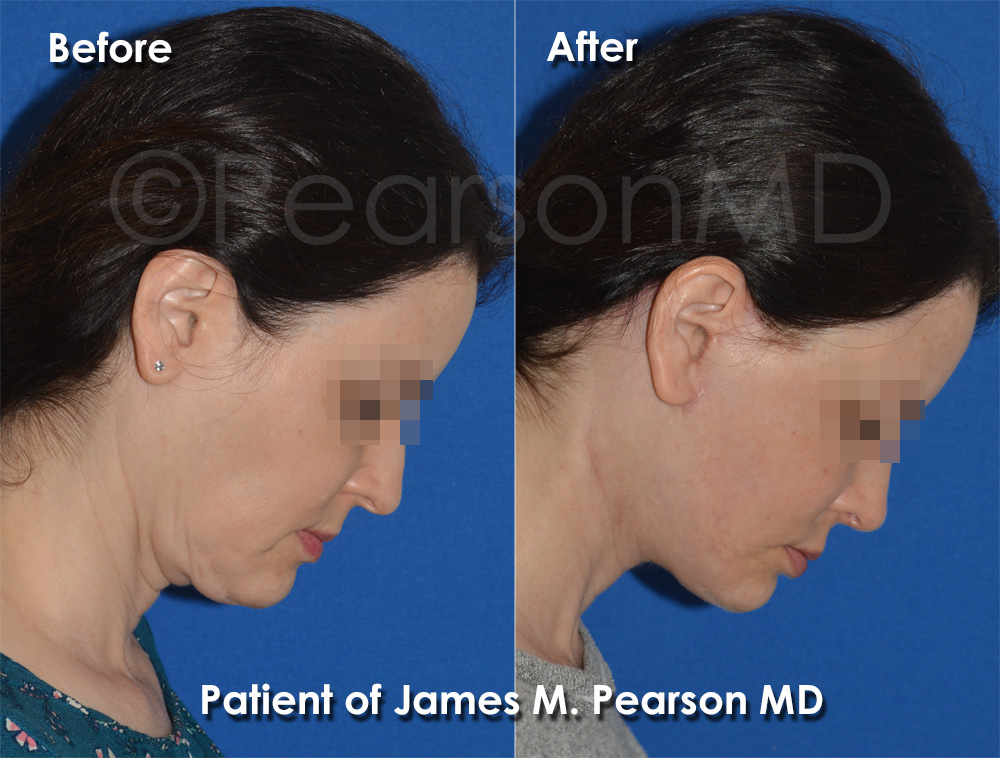 Hermosa Beach Facelift