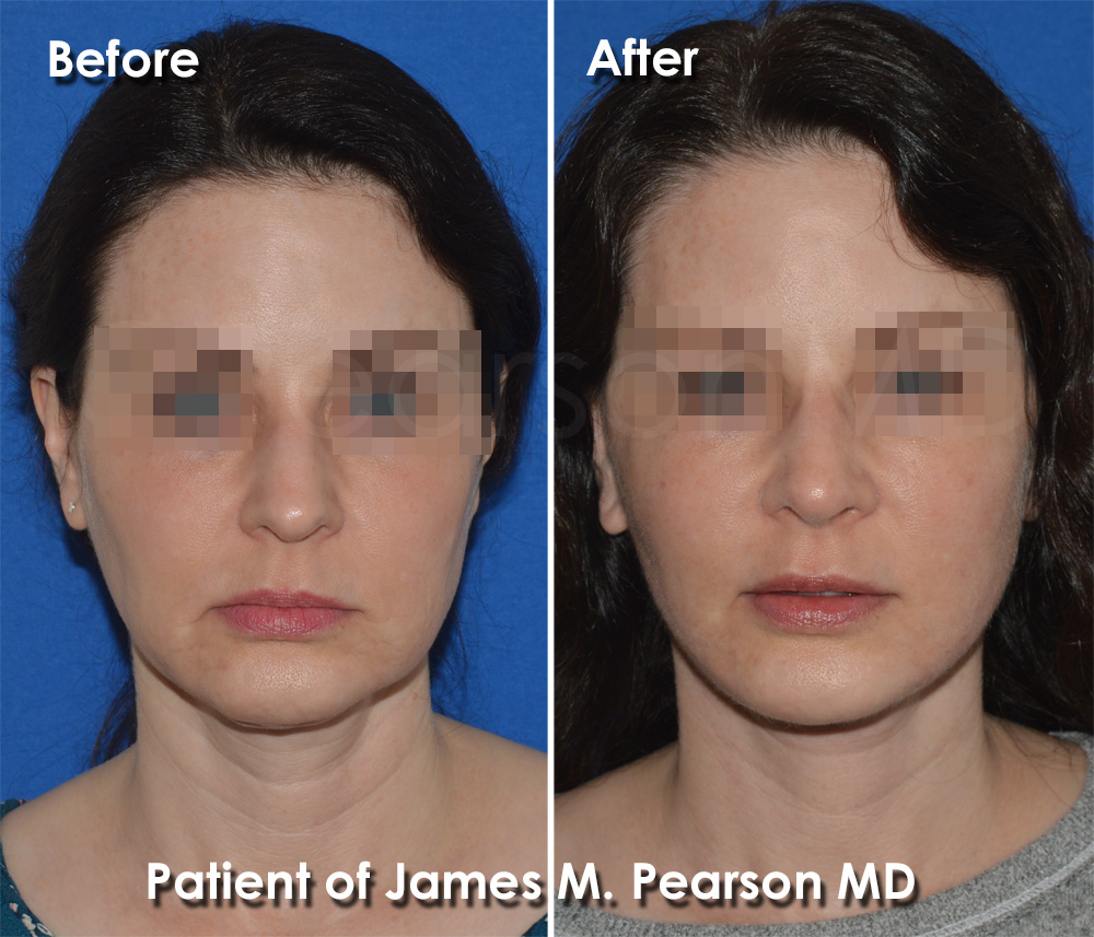 Palos Verdes Facelift