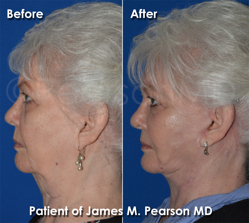Pearson Plastic Surgery
