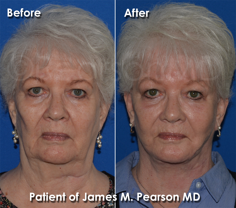 Dr. Pearson Facelift
