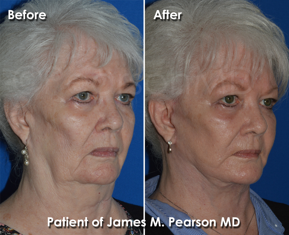Pearson Cosmetic Surgery