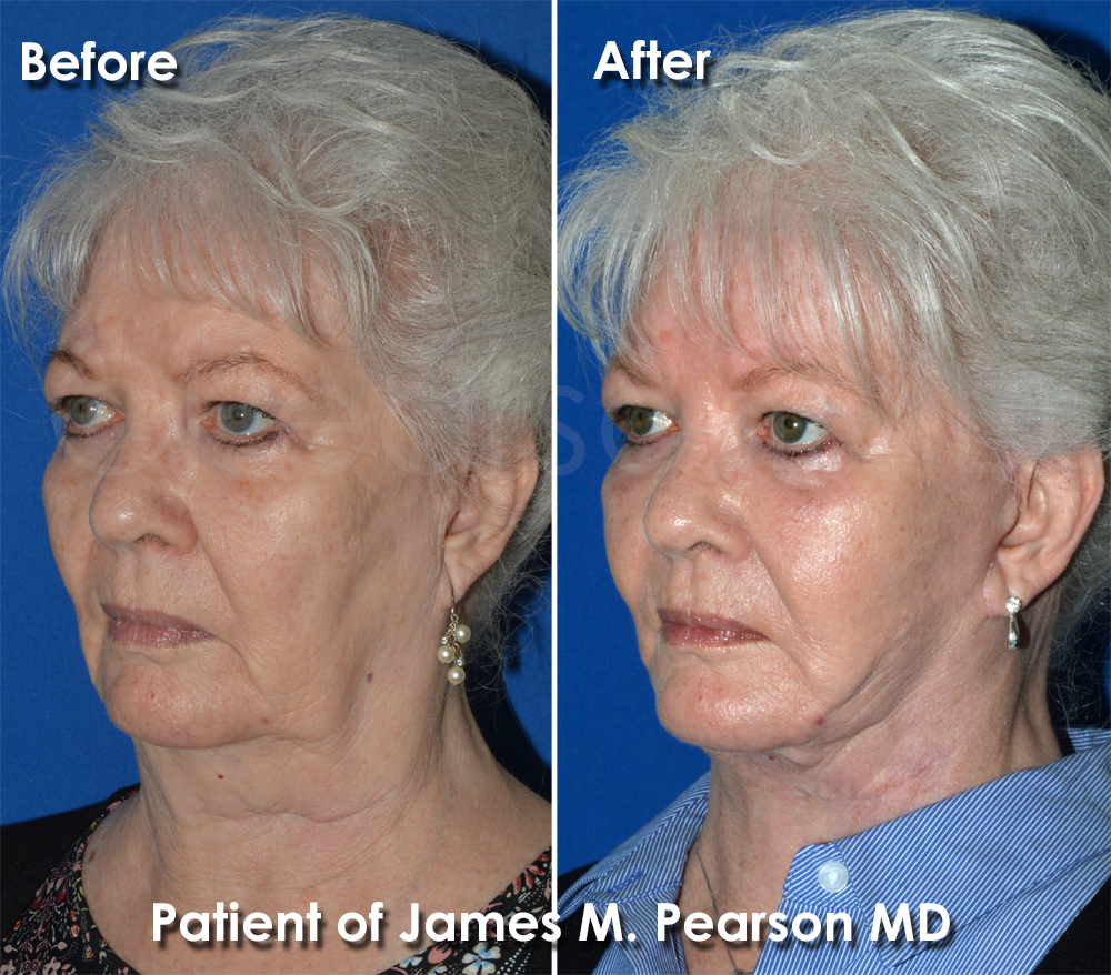 Pearson Plastic Surgery