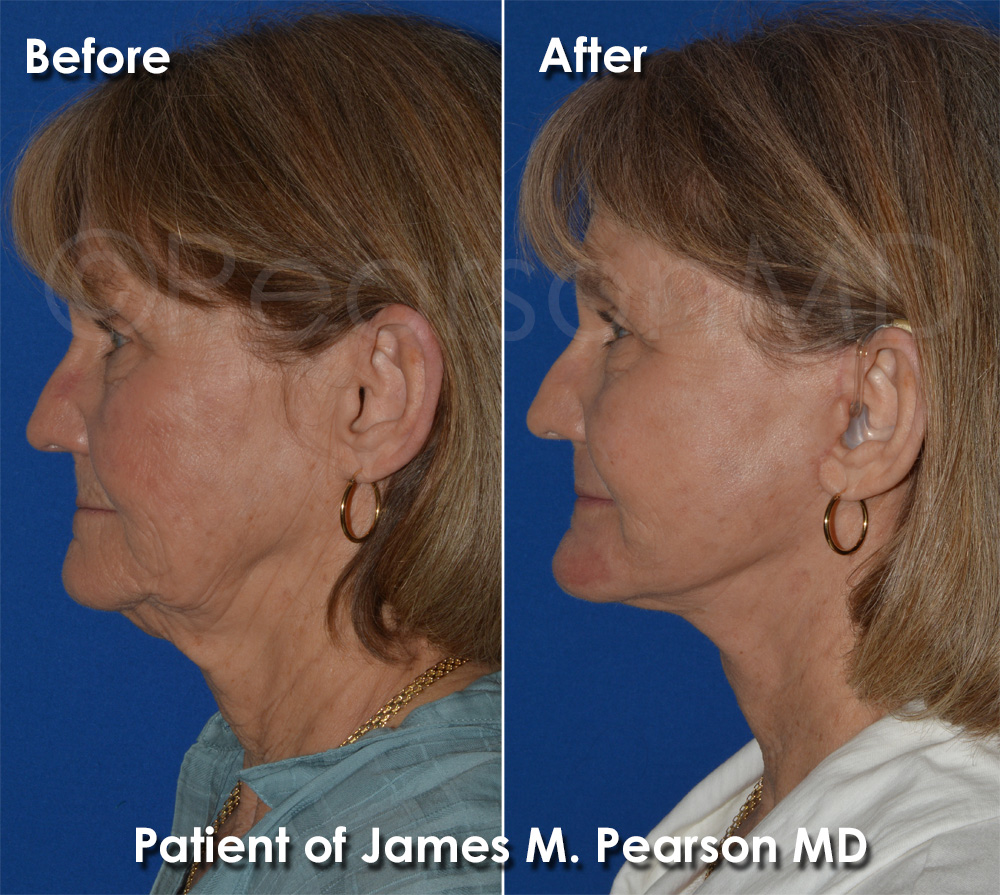 Dr. Pearson Plastic Surgery