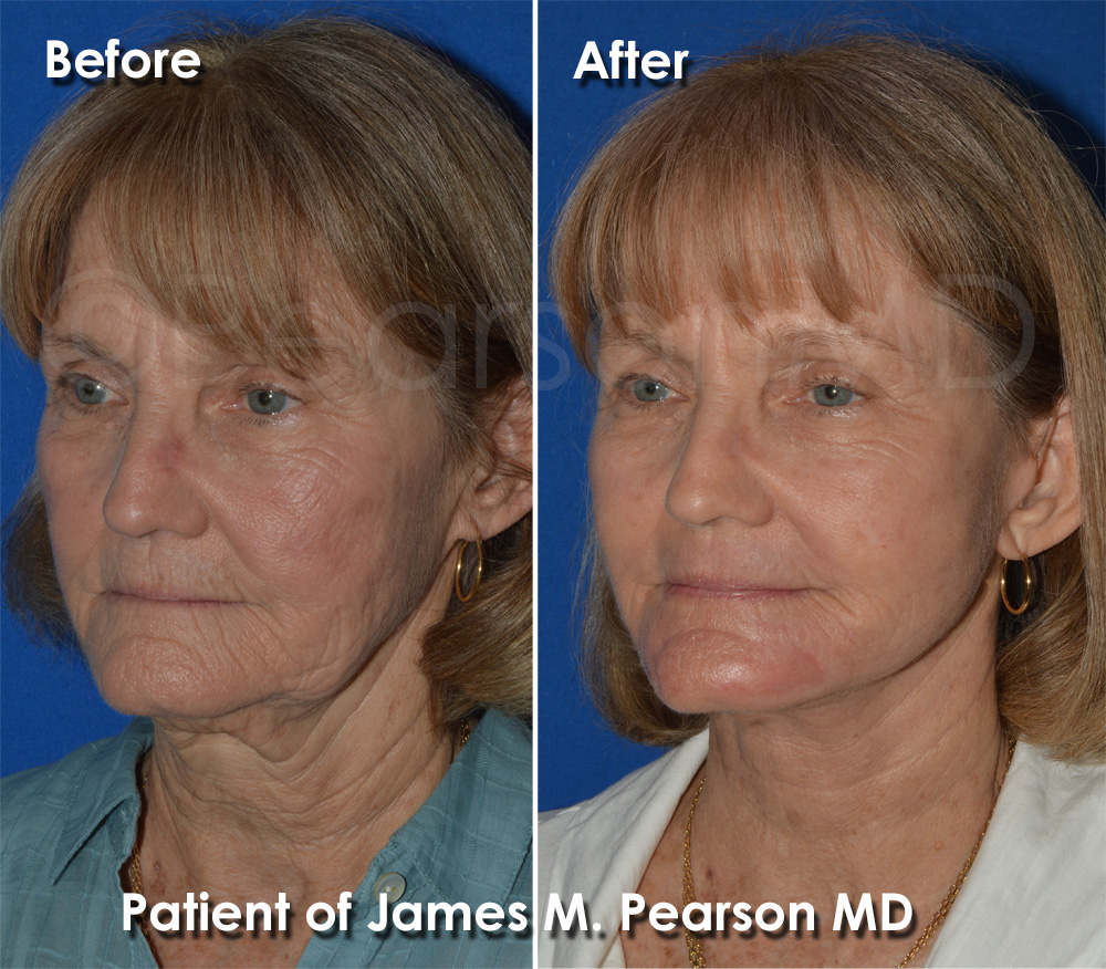 Dr. Pearson Facial Plastic Surgeon
