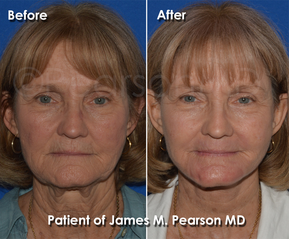 Dr. Pearson Facelift