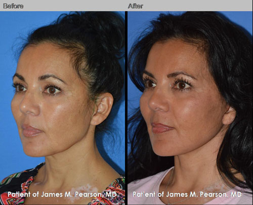 Pearson Facelift Photos