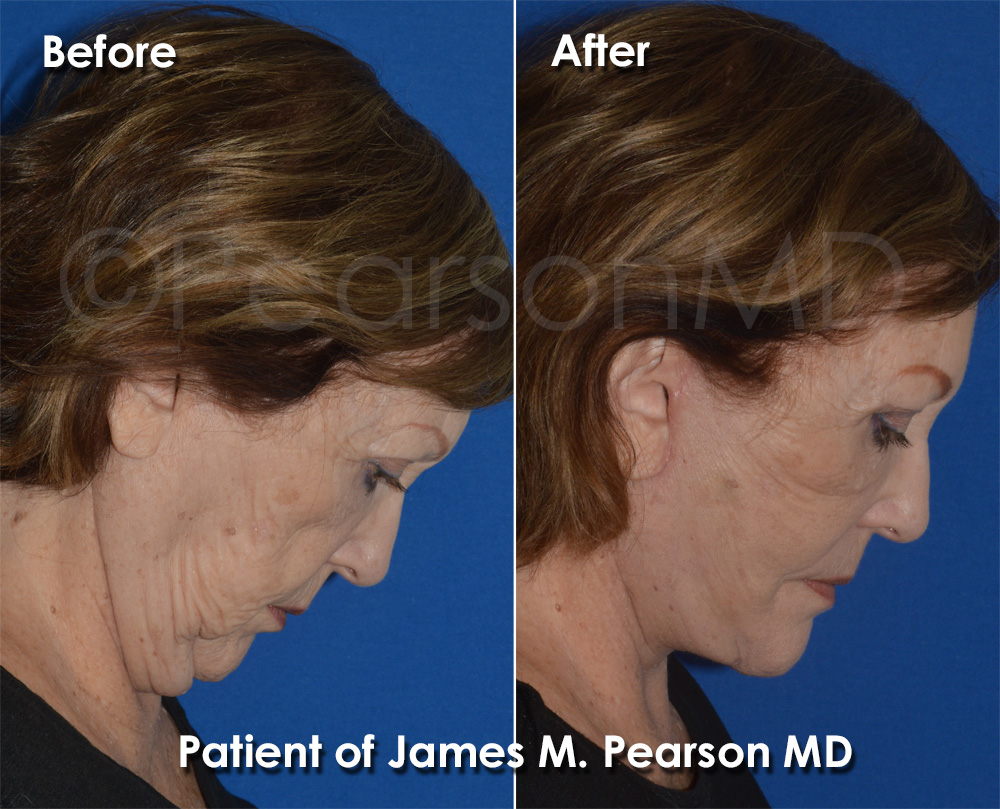 Dr. Pearson Plastic Surgery