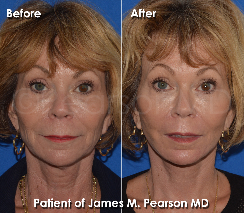 Dr. Pearson Plastic Surgery