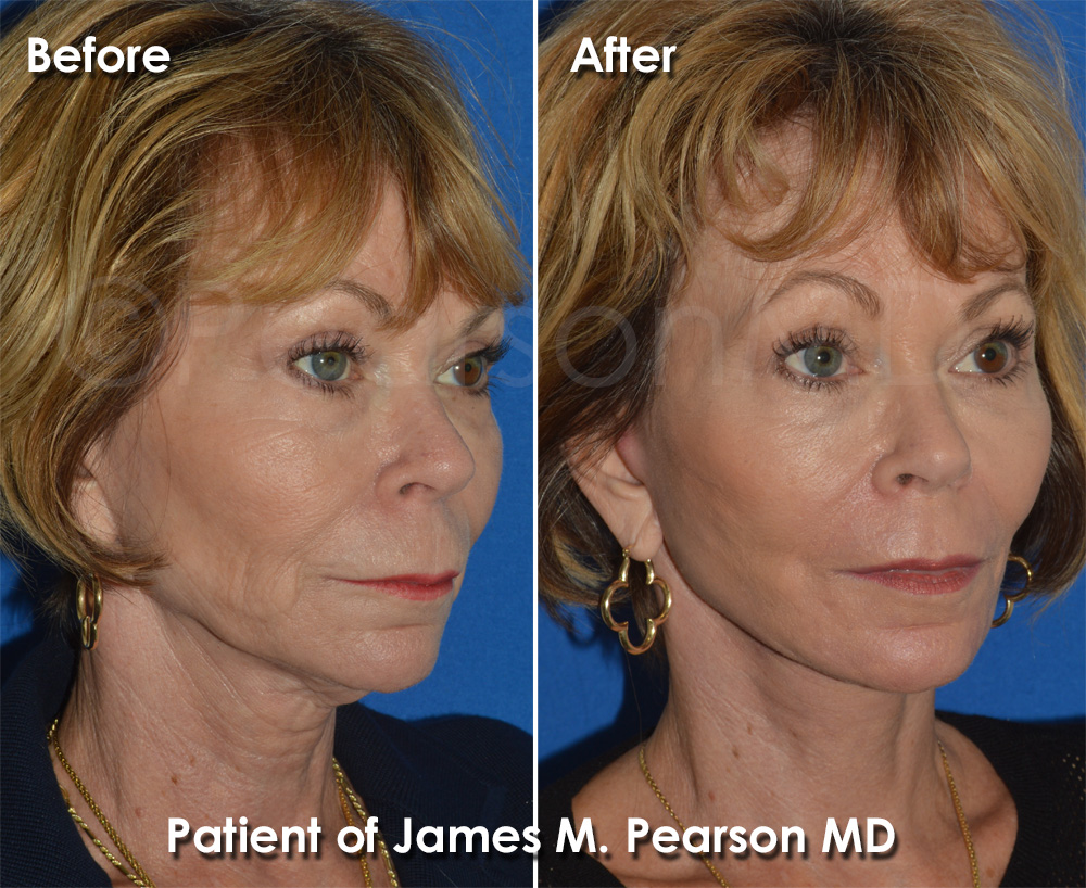 Pearson Plastic Surgery