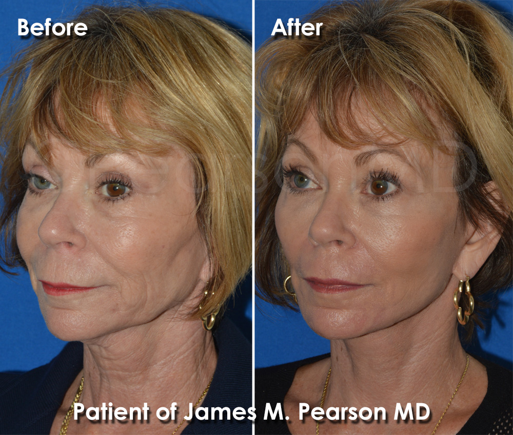 Pearson Facelift