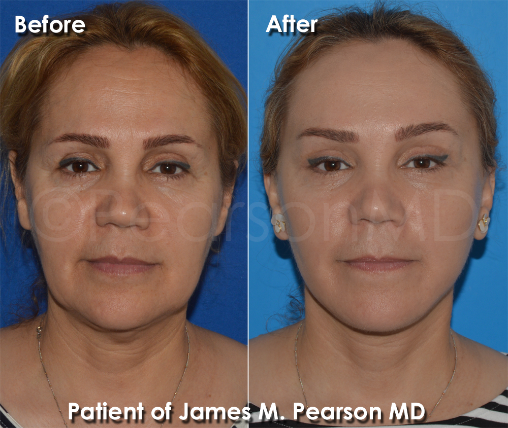 Dr. Pearson Plastic Surgery