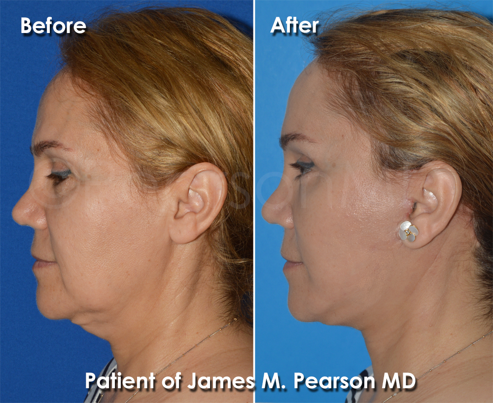 Pearson Plastic Surgery