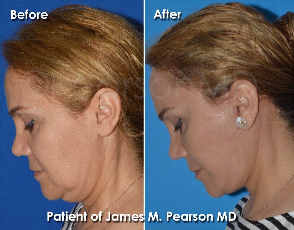 Pearson Plastic Surgery