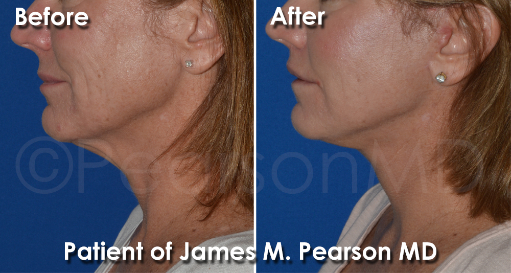 Venice Facelift