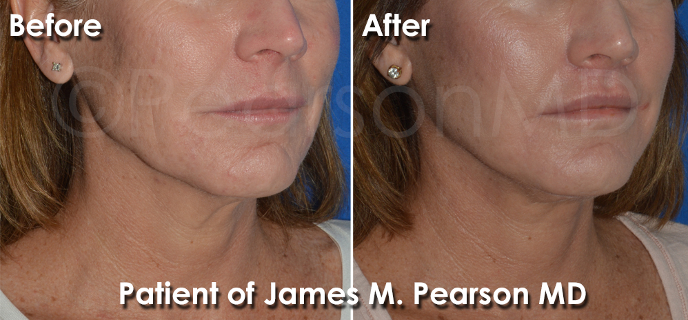 Manhattan Beach Facelift
