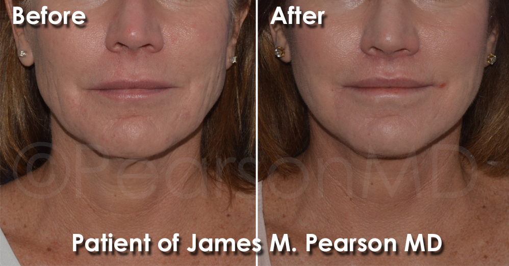 Playa Vista Beach Facelift