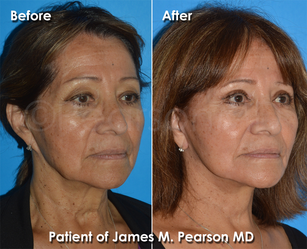 Dr. Pearson Facelift