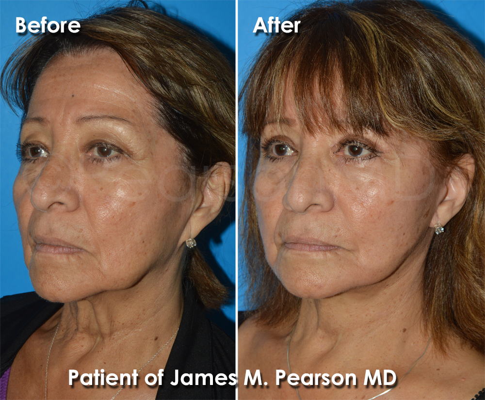 Pearson Plastic Surgery