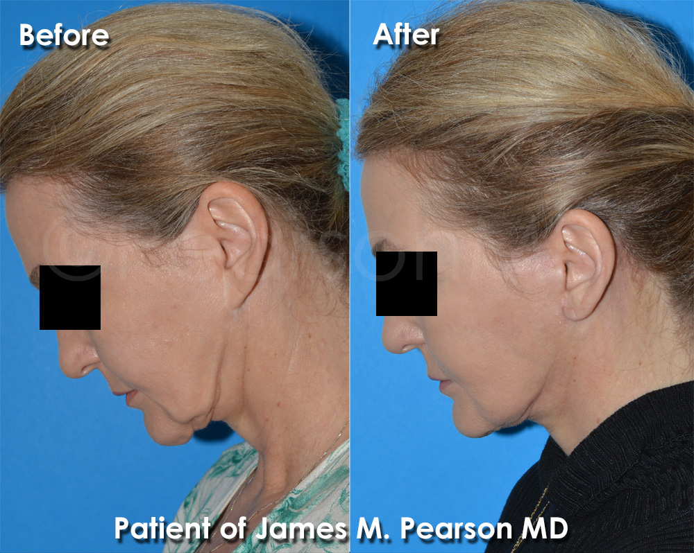 Dr. Pearson Facelift