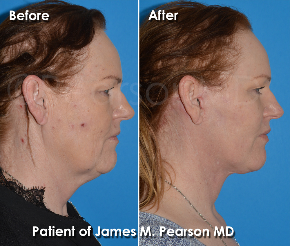 Facelift Hermosa Beach