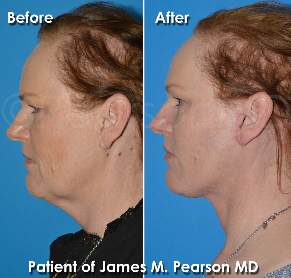 Pearson Plastic Surgery