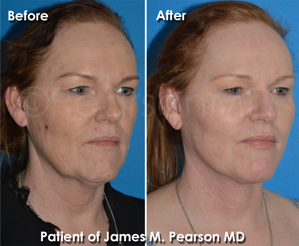 Pearson Cosmetic Surgery