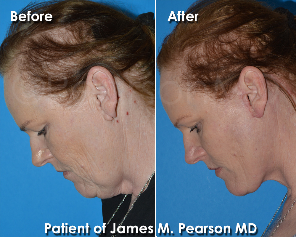 Facelift Redondo Beach