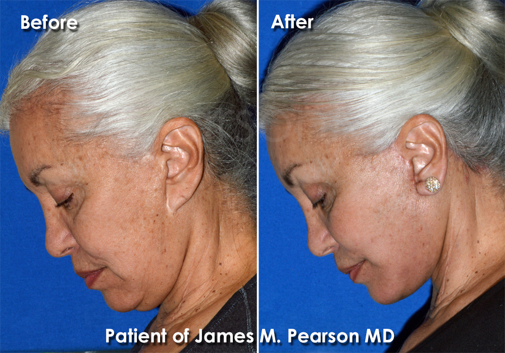 Pearson Plastic Surgery