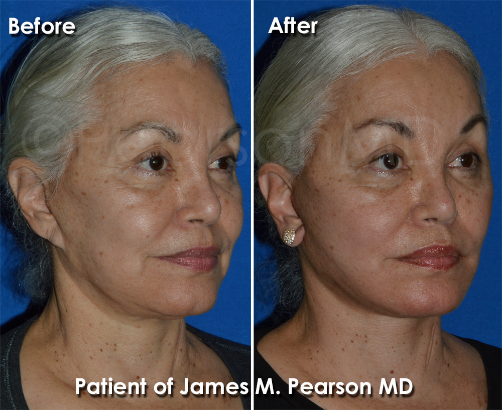 Pearson Facelift