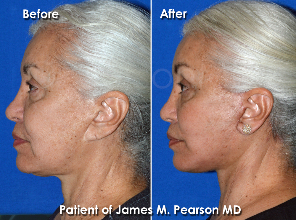 Facelift Manhattan Beach