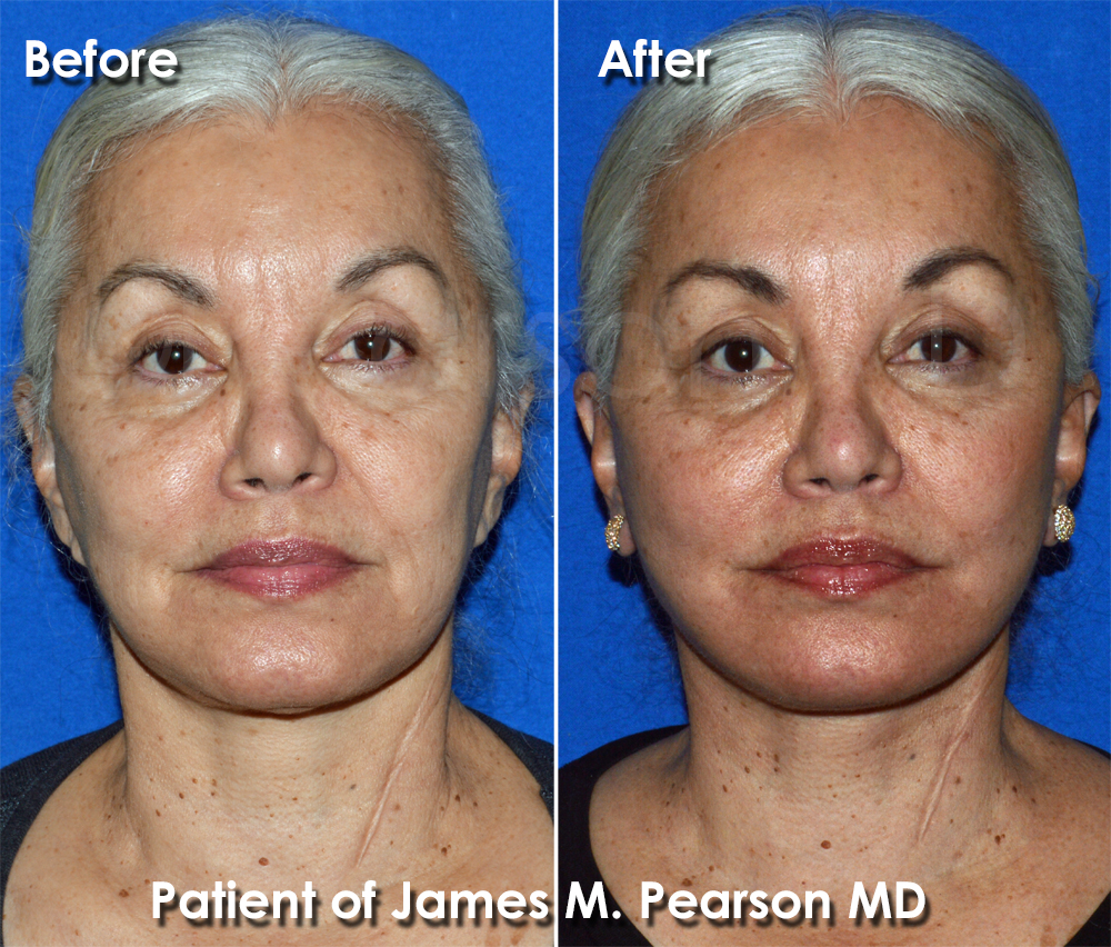 Facelift Torrance
